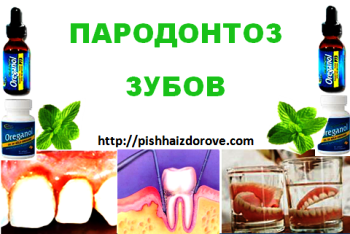 Пародонтоз зубов