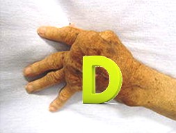 Vitamin-D- and-rheumatoid-arthritis