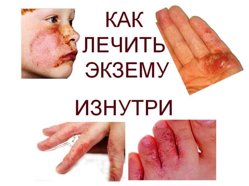How-to-treat-eczema-from-the-inside
