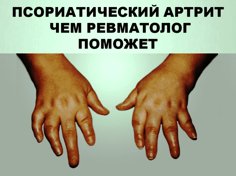 Psoriatic-arthritis